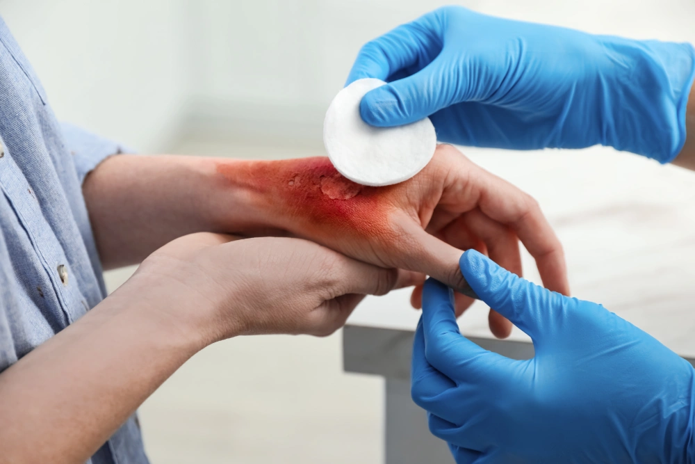Burn injury attorney helping a victim with medical care and a personal injury claim